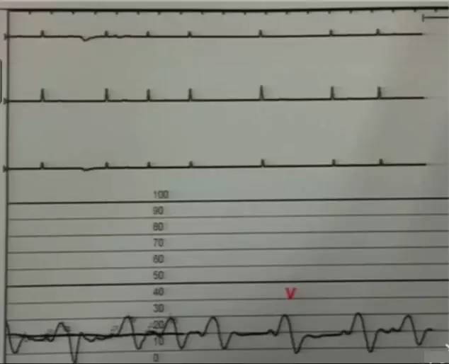 心脏增大引发的心衰能治好吗,急性心衰引起心脏扩大能治愈吗