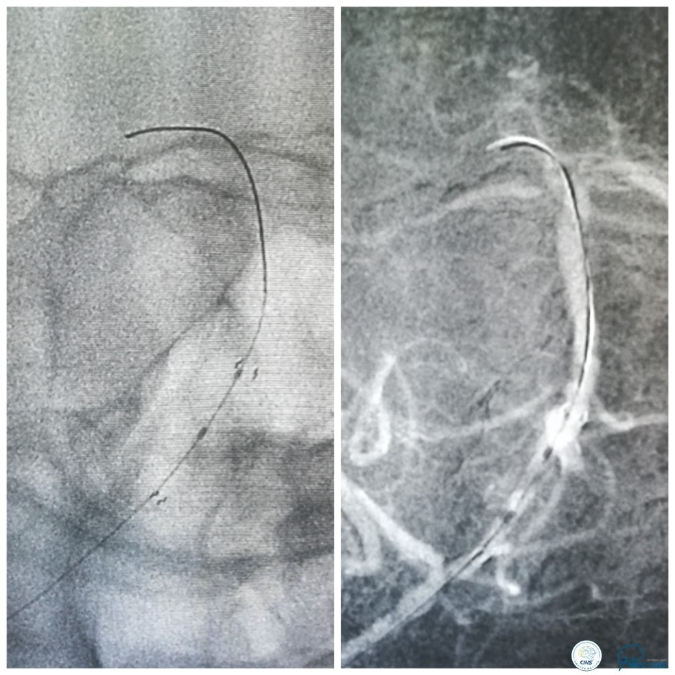 天坛周记｜右椎动脉V1段及V4-基底动脉串联病变支架治疗一例