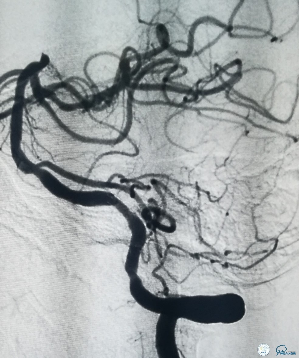 天坛椎动脉狭窄,天坛周记