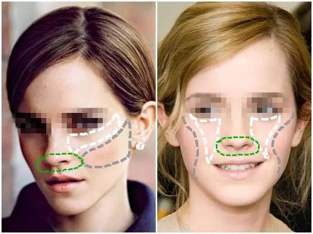 美女与野兽｜天生法令纹只能靠整容吗？那是因为你没看这篇！