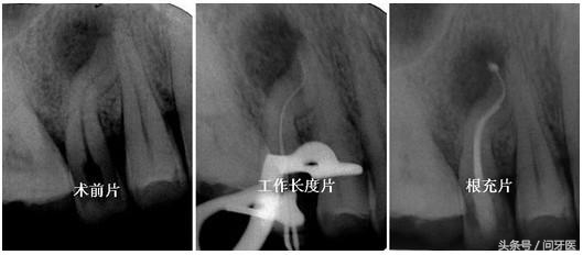 为什么杀牙神经不能全麻,烤瓷牙杀了神经几年牙突然疼