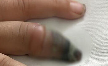 浙江4岁女孩拔手指,4岁女孩被刺伤自救