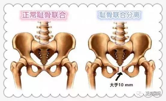 耻骨联合分离,那些莫名其妙的痛,你知多少?