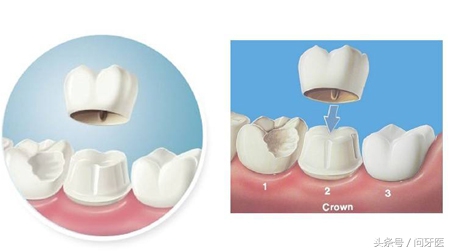 为什么杀牙神经不能全麻,烤瓷牙杀了神经几年牙突然疼
