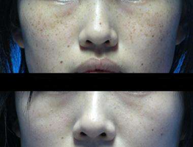 激光治疗雀斑要多少钱,中医治疗雀斑靠谱吗