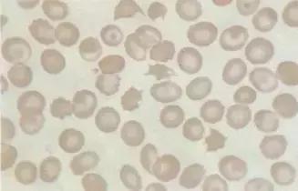 外周血细胞涂片的正常值,外周血细胞分析多长时间出结果