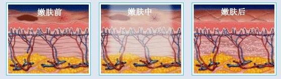 皮肤敏感泛红怎么选择光子嫩肤,油性皮肤怎么推荐光子嫩肤