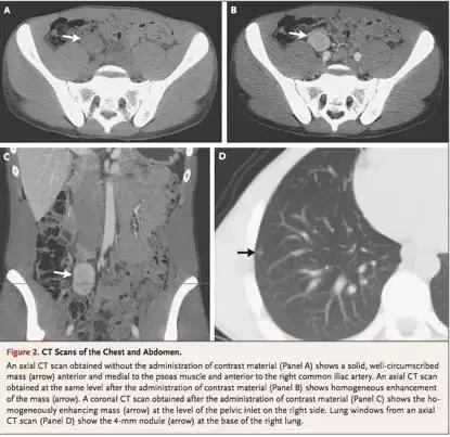 男性右下腹部囊性包块,男性右侧盆腔囊性包块