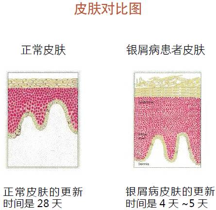银屑病本质上不属于皮肤病,银屑病是普通的癣吗