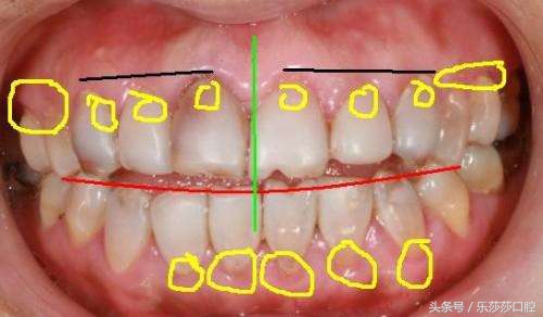 烤瓷牙牙基烂没了怎么办,烤瓷牙会变形状吗