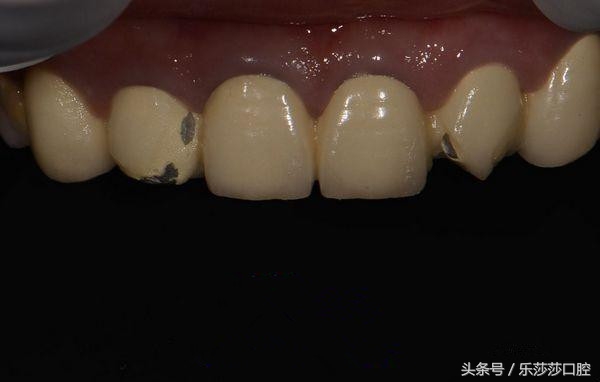 烤瓷牙牙基烂没了怎么办,烤瓷牙会变形状吗