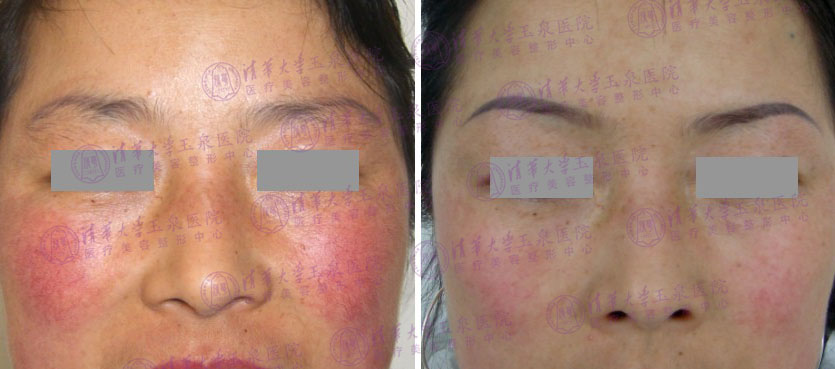 皮肤敏感泛红怎么选择光子嫩肤,油性皮肤怎么推荐光子嫩肤