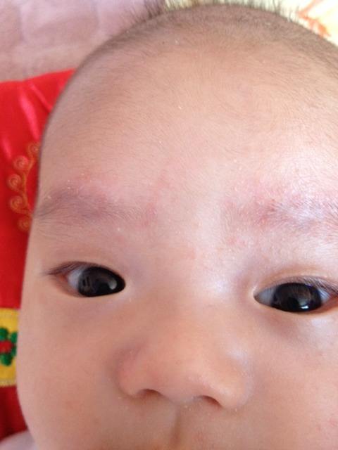 宝宝一急眉毛处就红怎么回事,宝宝眉毛发红是怎么回事