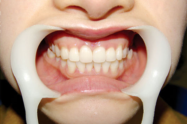 牙痛有什么不用药的小妙招,牙痛吃什么药可以治愈