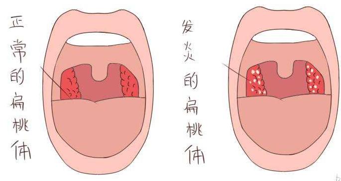急性扁桃体炎按哪个穴位,急性扁桃体炎针灸哪个穴位