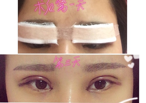 内双可以做埋线双眼皮整个过程,内双做埋线双眼皮会变成三眼皮吗