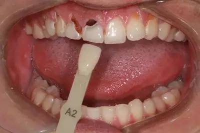 可乐牙治疗实拍,可乐牙治疗好前后图片