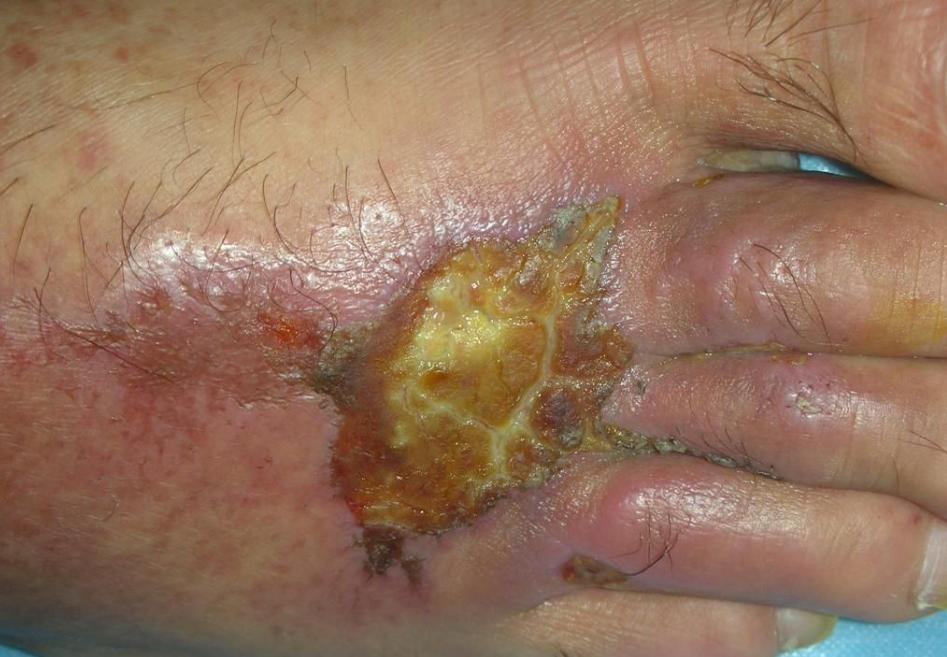 身体有这些症状要注意,肚子里有寄生虫的症状吃什么药