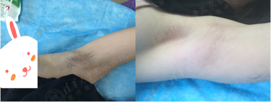 激光脱毛有什么弊端,为什么激光脱毛效果不好