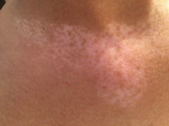 有人说白癜风治不好真的吗,白癜风谣言汇总