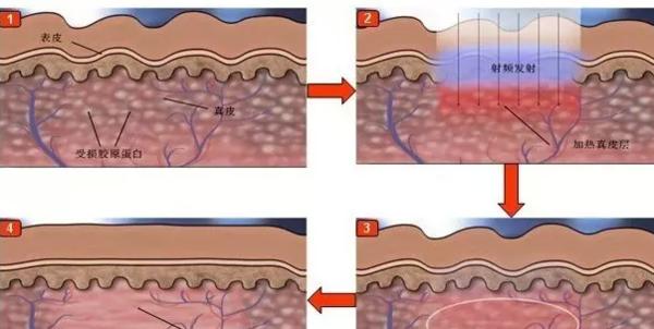 超声刀和热拉提,热玛吉超声刀热拉提哪个好