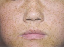 激光治疗雀斑要多少钱,中医治疗雀斑靠谱吗