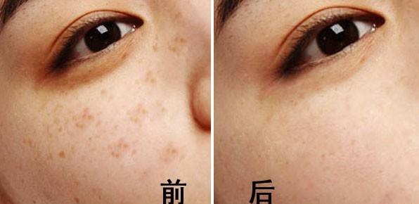 激光治疗雀斑要多少钱,中医治疗雀斑靠谱吗