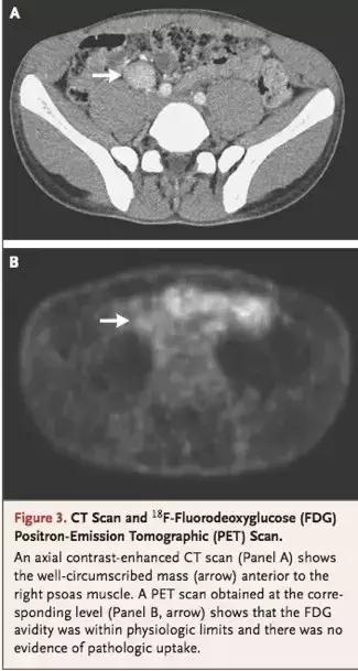男性右下腹部囊性包块,男性右侧盆腔囊性包块