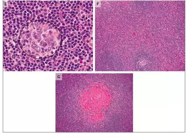 男性右下腹部囊性包块,男性右侧盆腔囊性包块