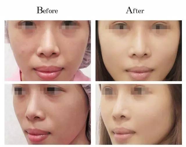 美女与野兽｜天生法令纹只能靠整容吗？那是因为你没看这篇！