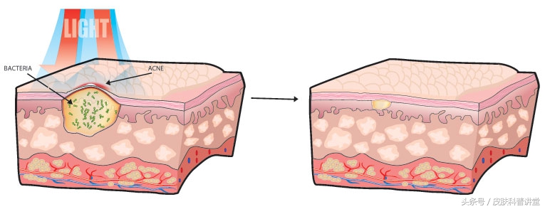 治疗疮疤中药,痔疮内服外用效果更好吗