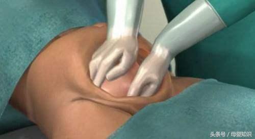 剖腹产疤痕误区,剖腹产常见的最基本的问题