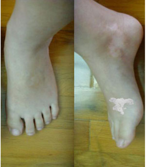 白斑治疗如何才能成功,老年性白斑治疗小妙招