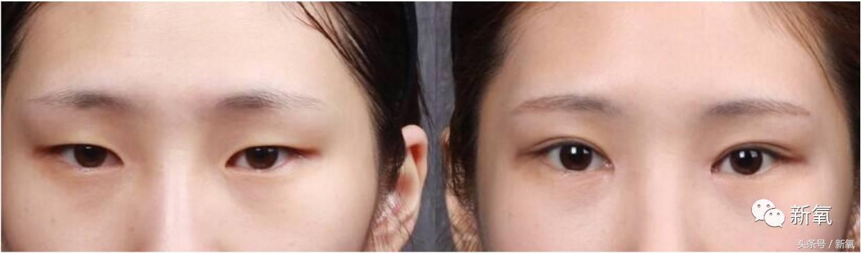 为什么开眼角会变漂亮,为什么开眼角很奇怪