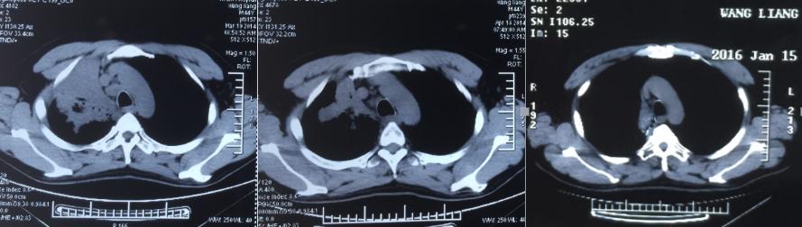肺癌晚期4期可以治疗痊愈吗,肺癌晚期4b靶向治疗能活多久