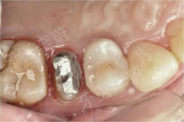 前牙残根桩冠修复,前磨牙嵌体修复