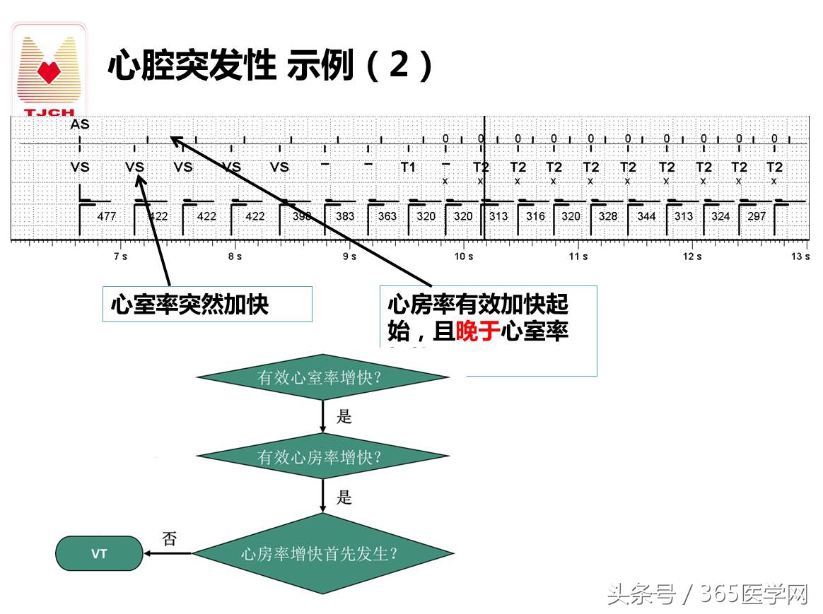 许静：新技术避免ICD不恰当放电