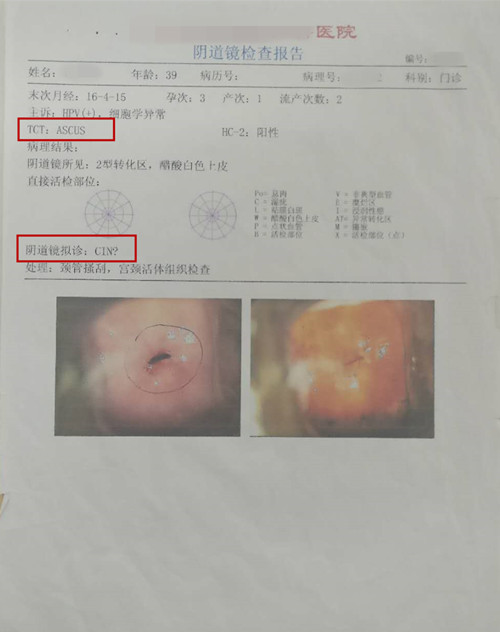 面部疣hpv,非青春期痤疮跟hpv有关系吗