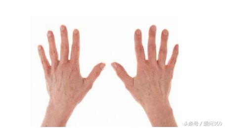 手上长湿疹因为湿气重吗,手上突然长湿疹怎么办