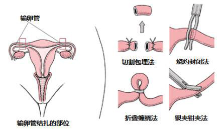 男性结扎还是女性结扎伤害大,结扎对女性的伤害