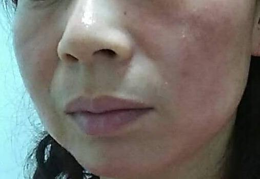 要怎么治疗红血丝最好的方法,红血丝治疗方法帮你快速去红