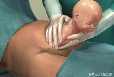 剖腹产疤痕误区,剖腹产常见的最基本的问题