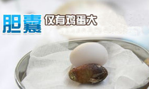 保守治疗胆结石有什么偏方可以治,胆结石有没有偏方治疗