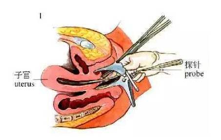节育环取出注意些什么,女性节育环取环前注意事项