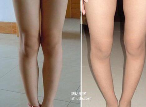 腿型不直如何矫正,老年人长时间大腿弯曲该怎样矫正