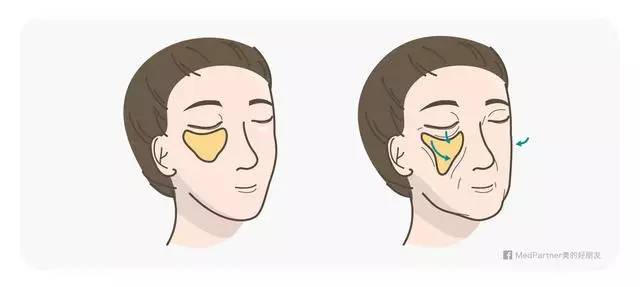 美女与野兽｜天生法令纹只能靠整容吗？那是因为你没看这篇！