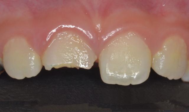 孩子牙疼吃点消炎药几天就能好,孩子牙疼吃消炎药