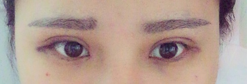 内双可以做埋线双眼皮整个过程,内双做埋线双眼皮会变成三眼皮吗