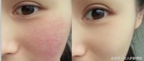 喝中药能治疗神经性皮炎吗,喝中药能引起皮炎吗