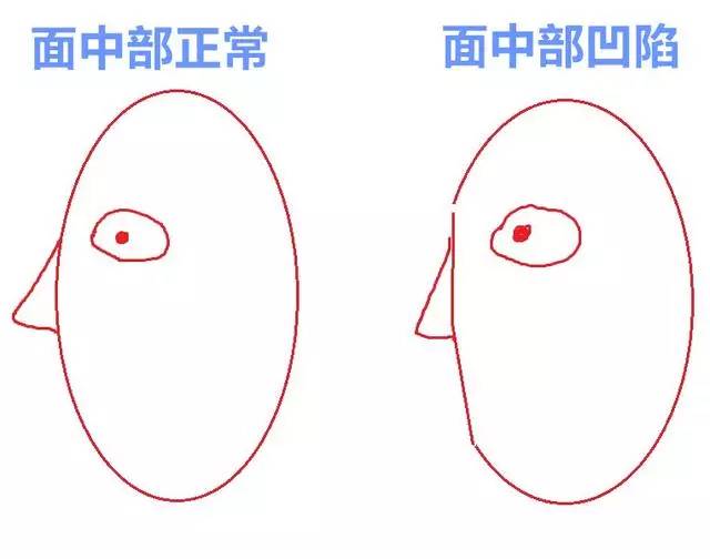 美女与野兽｜天生法令纹只能靠整容吗？那是因为你没看这篇！